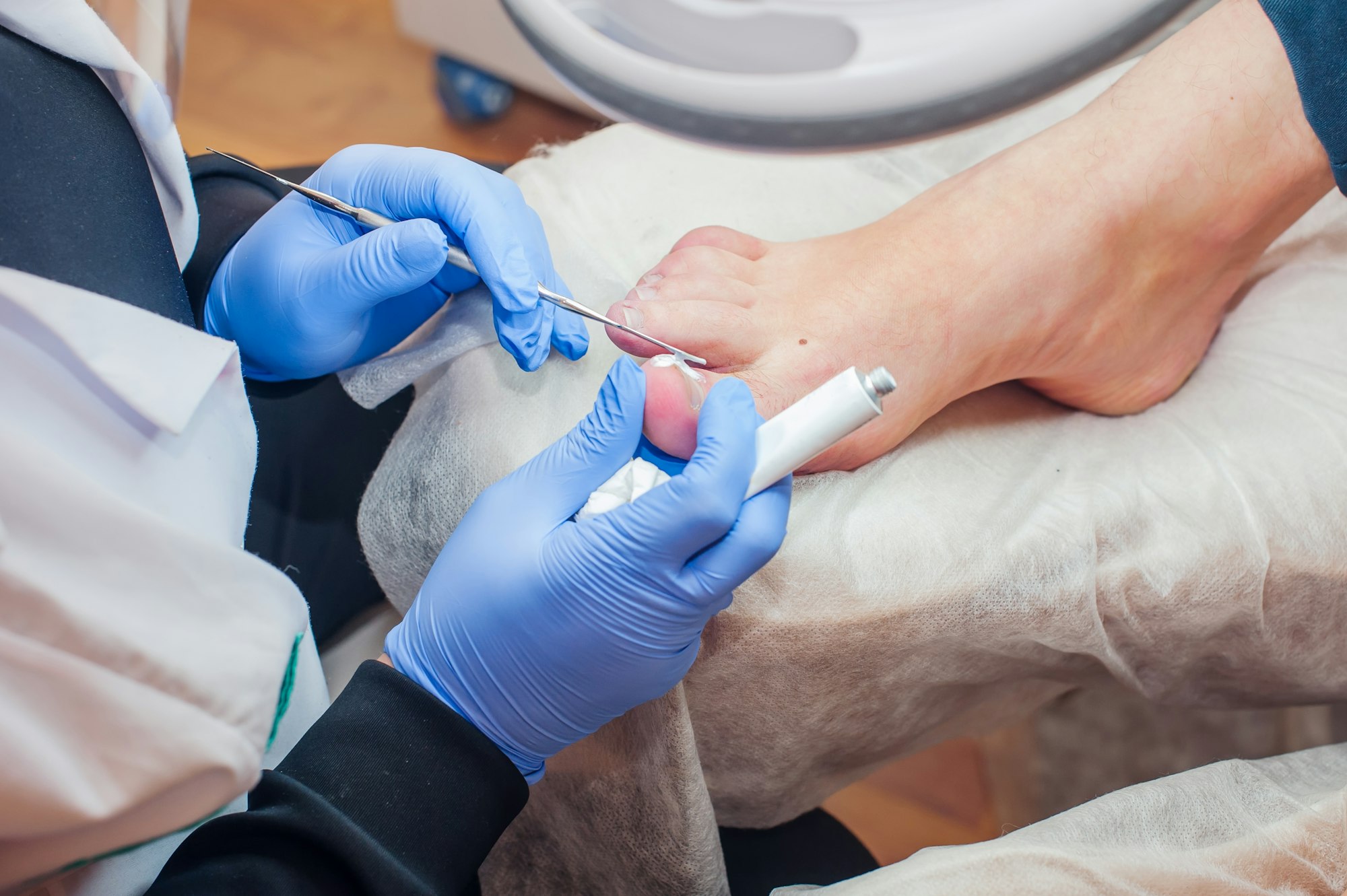 Podology treatment. Podiatrist treating toenail fungus. Doctor applying cream on removed ingrown nai